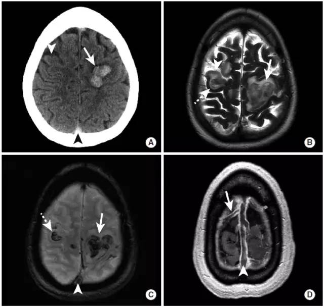 颅内出血影像学表现大全