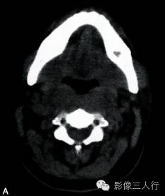 【病例】颈部朗格汉斯细胞组织细胞增生症1例CT影像表现