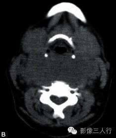 【病例】颈部朗格汉斯细胞组织细胞增生症1例CT影像表现