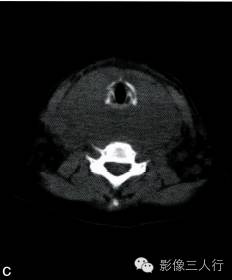 【病例】颈部朗格汉斯细胞组织细胞增生症1例CT影像表现