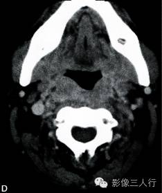 【病例】颈部朗格汉斯细胞组织细胞增生症1例CT影像表现