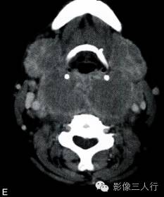 【病例】颈部朗格汉斯细胞组织细胞增生症1例CT影像表现