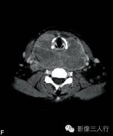 【病例】颈部朗格汉斯细胞组织细胞增生症1例CT影像表现