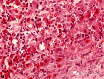 【病例】颈部朗格汉斯细胞组织细胞增生症1例CT影像表现