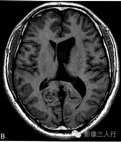 【病例】室管膜下瘤1例CT及MR影像表现分析 【病例】室管膜下瘤1例CT及MR影像表现分析