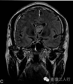 【病例】室管膜下瘤1例CT及MR影像表现分析 【病例】室管膜下瘤1例CT及MR影像表现分析