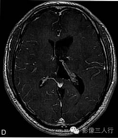 【病例】室管膜下瘤1例CT及MR影像表现分析 【病例】室管膜下瘤1例CT及MR影像表现分析