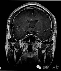 【病例】室管膜下瘤1例CT及MR影像表现分析 【病例】室管膜下瘤1例CT及MR影像表现分析