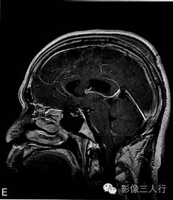 【病例】室管膜下瘤1例CT及MR影像表现分析 【病例】室管膜下瘤1例CT及MR影像表现分析