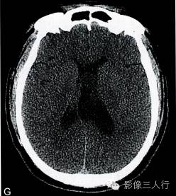 【病例】室管膜下瘤1例CT及MR影像表现分析 【病例】室管膜下瘤1例CT及MR影像表现分析
