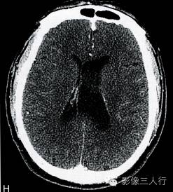 【病例】室管膜下瘤1例CT及MR影像表现分析 【病例】室管膜下瘤1例CT及MR影像表现分析