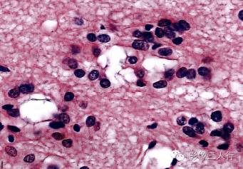 【病例】室管膜下瘤1例CT及MR影像表现分析 【病例】室管膜下瘤1例CT及MR影像表现分析