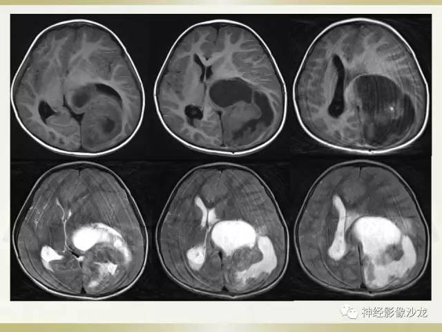 【病例】幕上脑实质内室管膜瘤1例CT及MR影像讨论