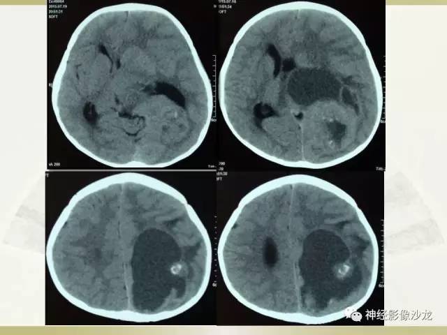 【病例】幕上脑实质内室管膜瘤1例CT及MR影像讨论