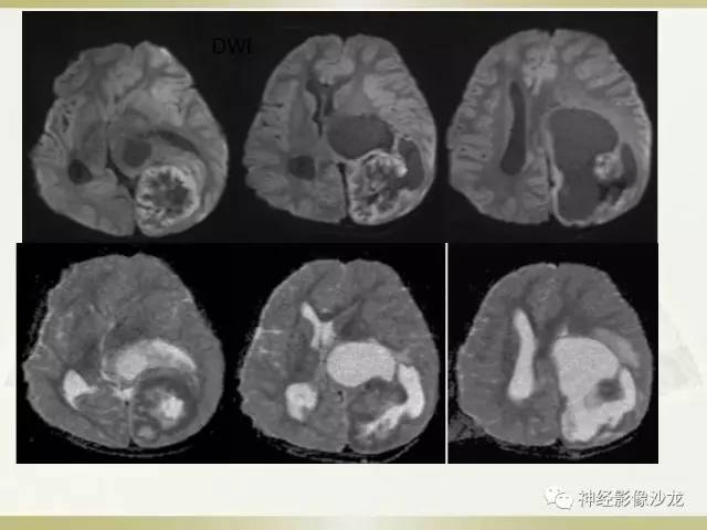 【病例】幕上脑实质内室管膜瘤1例CT及MR影像讨论