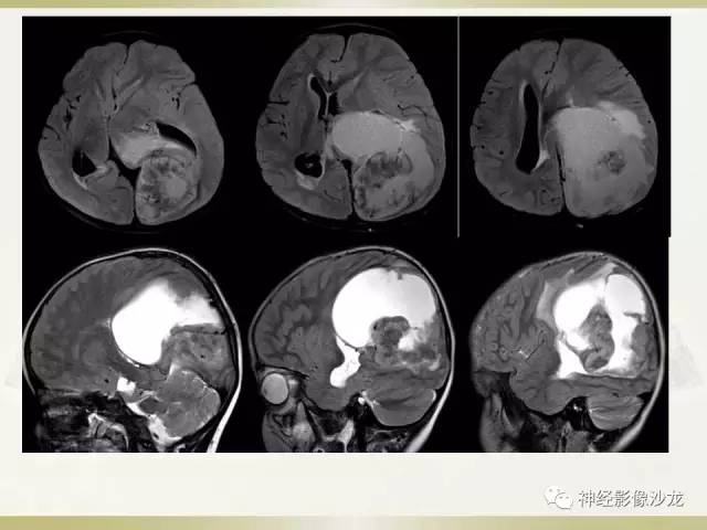 【病例】幕上脑实质内室管膜瘤1例CT及MR影像讨论