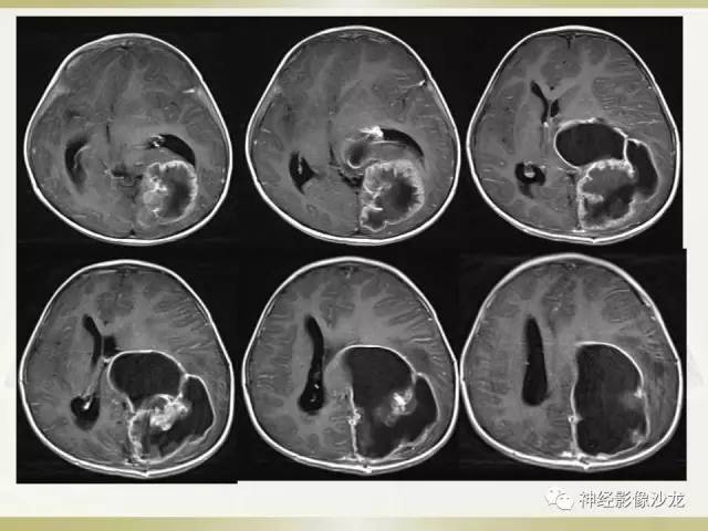 【病例】幕上脑实质内室管膜瘤1例CT及MR影像讨论