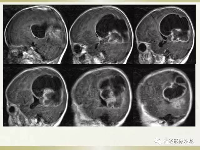 【病例】幕上脑实质内室管膜瘤1例CT及MR影像讨论