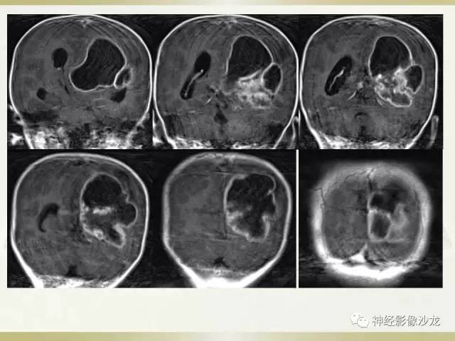 【病例】幕上脑实质内室管膜瘤1例CT及MR影像讨论