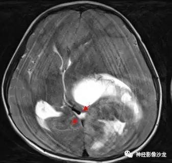 【病例】幕上脑实质内室管膜瘤1例CT及MR影像讨论