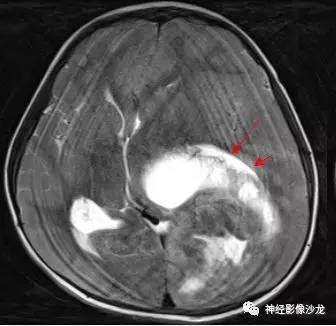 【病例】幕上脑实质内室管膜瘤1例CT及MR影像讨论
