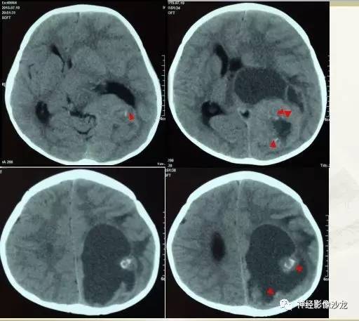【病例】幕上脑实质内室管膜瘤1例CT及MR影像讨论