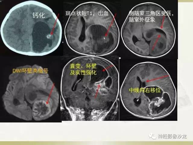 【病例】幕上脑实质内室管膜瘤1例CT及MR影像讨论