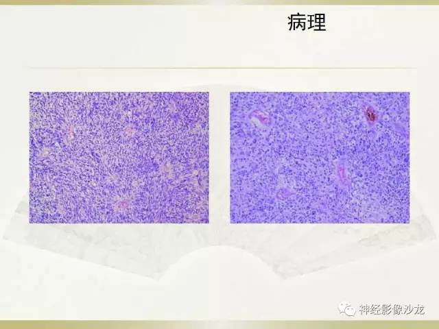 【病例】幕上脑实质内室管膜瘤1例CT及MR影像讨论