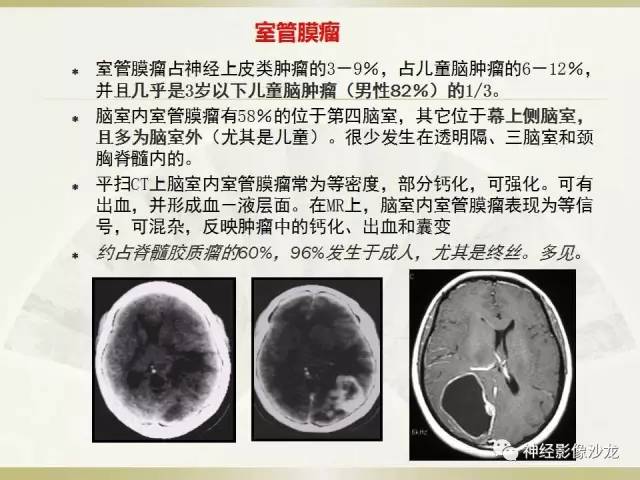 【病例】幕上脑实质内室管膜瘤1例CT及MR影像讨论