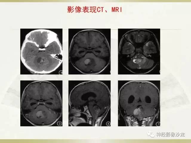 【病例】幕上脑实质内室管膜瘤1例CT及MR影像讨论