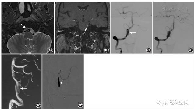 颅内动脉夹层的影像学诊断中国专家共识