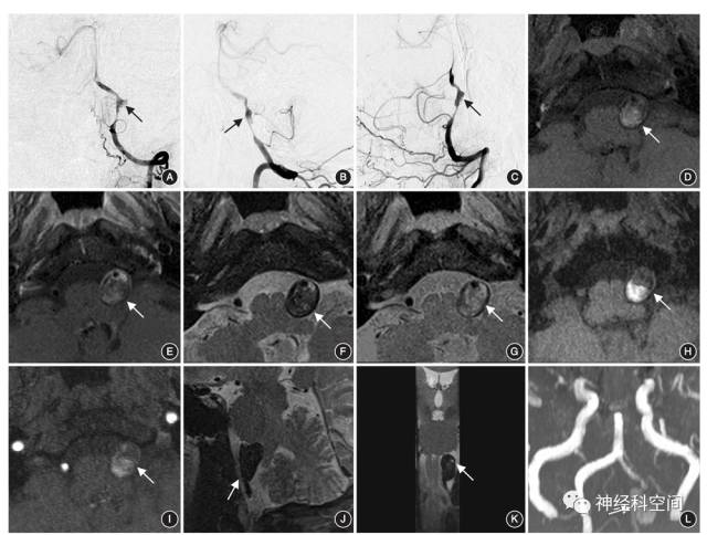 颅内动脉夹层的影像学诊断中国专家共识