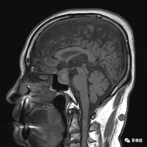 【病例】垂体瘤合并出血1例MR影像表现 【病例】垂体瘤合并出血1例MR影像表现