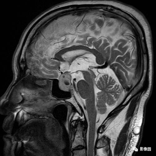【病例】垂体瘤合并出血1例MR影像表现 【病例】垂体瘤合并出血1例MR影像表现