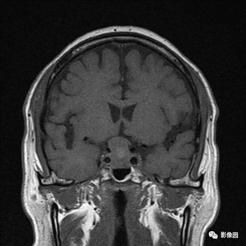 【病例】垂体瘤合并出血1例MR影像表现 【病例】垂体瘤合并出血1例MR影像表现
