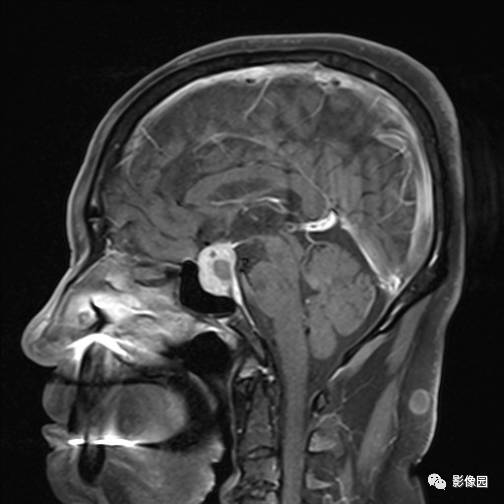 【病例】垂体瘤合并出血1例MR影像表现 【病例】垂体瘤合并出血1例MR影像表现