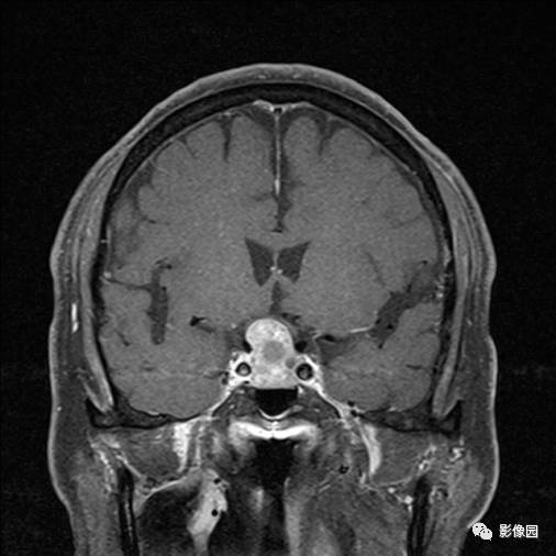 【病例】垂体瘤合并出血1例MR影像表现 【病例】垂体瘤合并出血1例MR影像表现