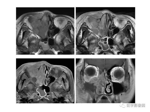 【PPT】鼻腔鼻窦肿瘤与肿瘤样病变的影像学诊断分析思路