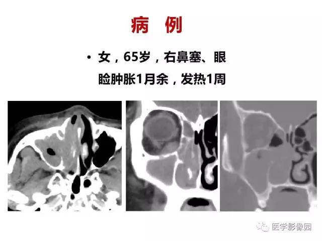 【PPT】鼻腔鼻窦肿瘤与肿瘤样病变的影像学诊断分析思路