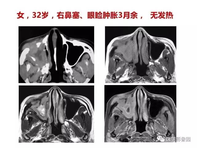 【PPT】鼻腔鼻窦肿瘤与肿瘤样病变的影像学诊断分析思路