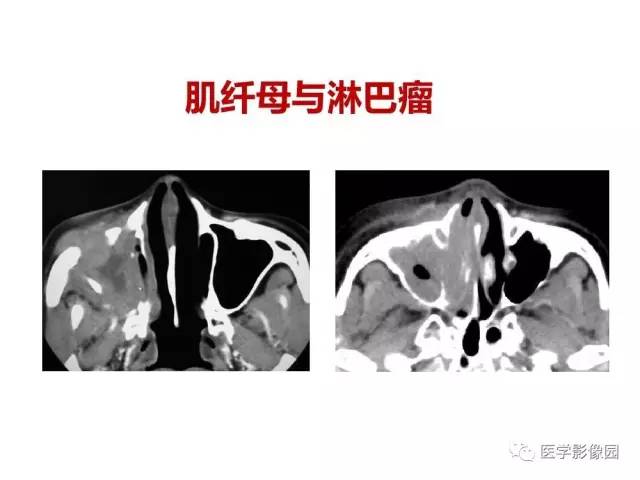 【PPT】鼻腔鼻窦肿瘤与肿瘤样病变的影像学诊断分析思路