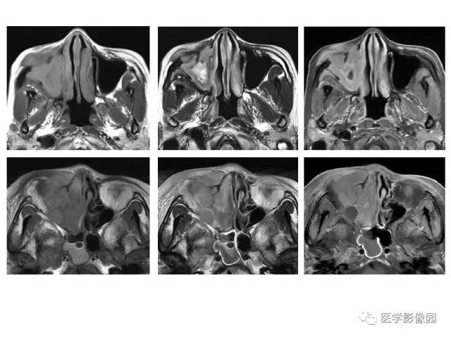 【PPT】鼻腔鼻窦肿瘤与肿瘤样病变的影像学诊断分析思路