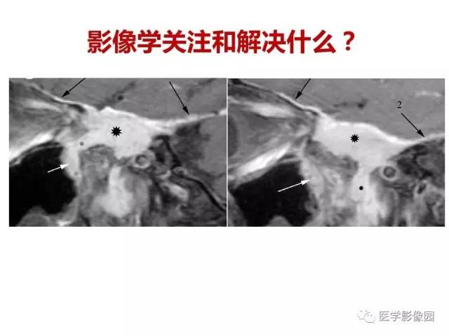【PPT】鼻腔鼻窦肿瘤与肿瘤样病变的影像学诊断分析思路