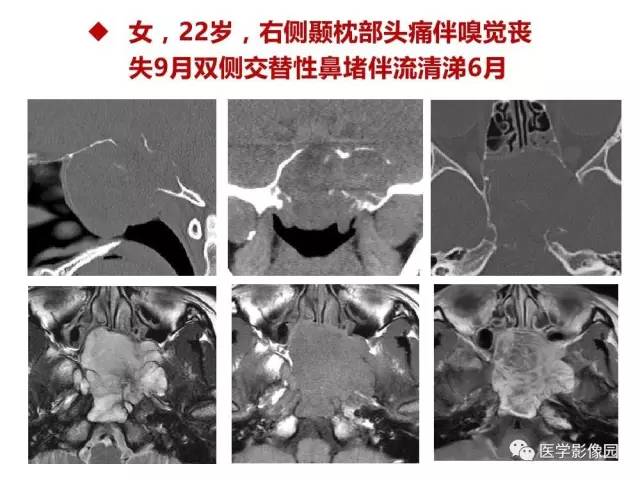 【PPT】鼻腔鼻窦肿瘤与肿瘤样病变的影像学诊断分析思路