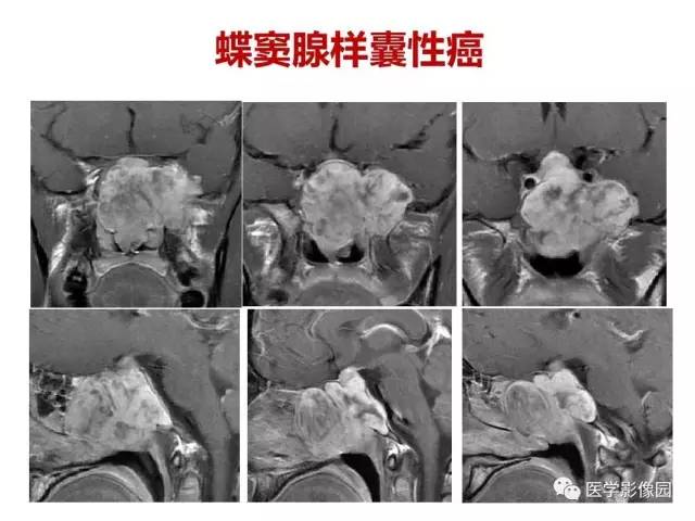 【PPT】鼻腔鼻窦肿瘤与肿瘤样病变的影像学诊断分析思路