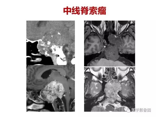 【PPT】鼻腔鼻窦肿瘤与肿瘤样病变的影像学诊断分析思路