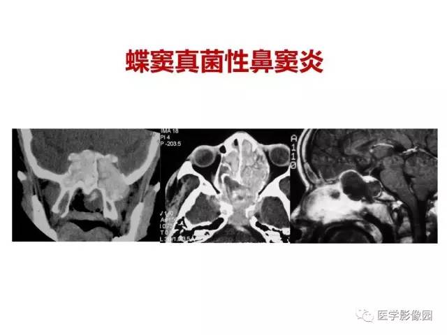 【PPT】鼻腔鼻窦肿瘤与肿瘤样病变的影像学诊断分析思路