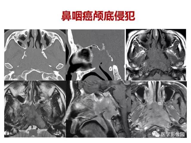 【PPT】鼻腔鼻窦肿瘤与肿瘤样病变的影像学诊断分析思路