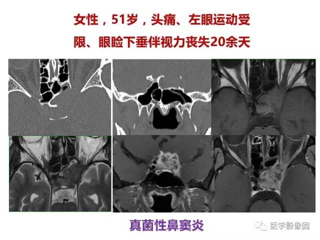 【PPT】鼻腔鼻窦肿瘤与肿瘤样病变的影像学诊断分析思路