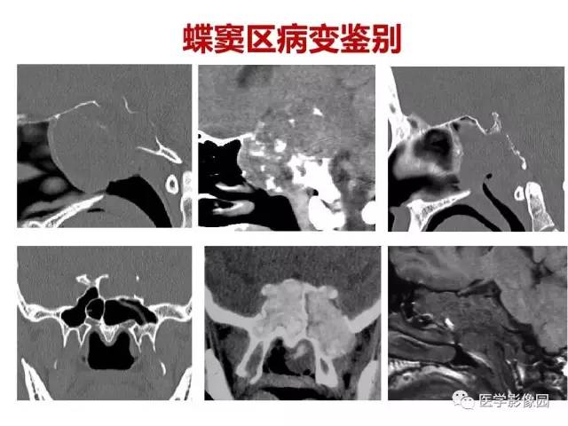 【PPT】鼻腔鼻窦肿瘤与肿瘤样病变的影像学诊断分析思路